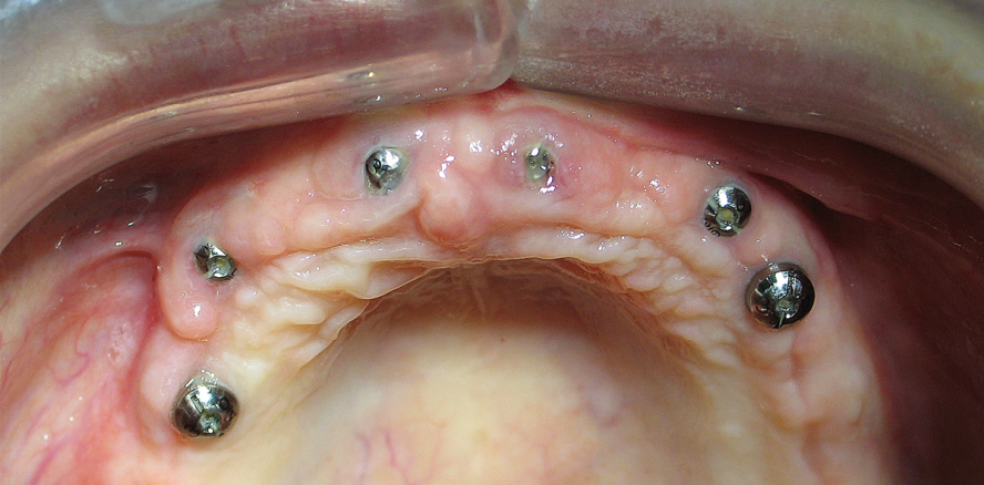 Rehabilitation des Gesamtkiefers mit verschraubbarer Suprakonstruktion
