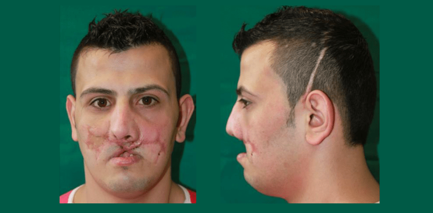 Syrer erhält neues Gesicht durch mikrochirurgische Rekonstruktion