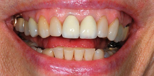 Ästhetische Ergebnisse mit transgingival einheilenden Implantaten