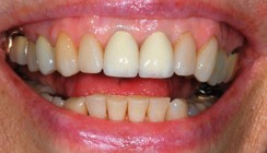 Ästhetische Ergebnisse mit transgingival einheilenden Implantaten