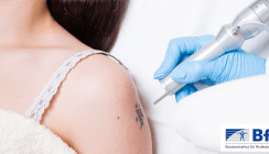 Tattoos: Auch der Abschied ist nicht ohne Risiko