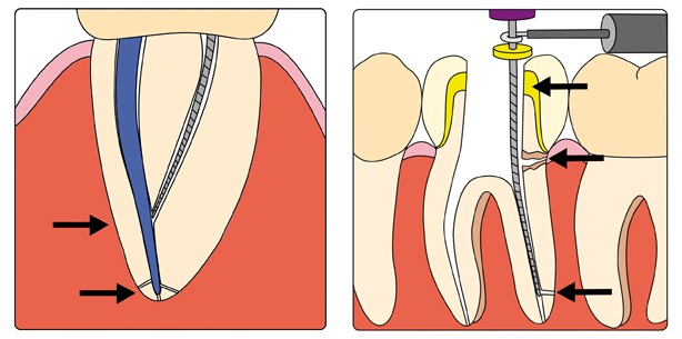 Bestimmung der endodontischen Arbeitslänge