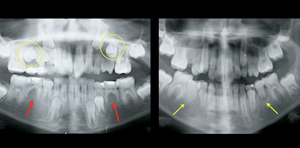 Autotransplantation von im Wurzelwachstum befindlichen Prämolaren