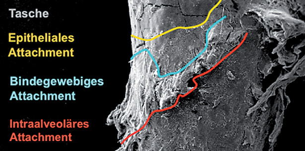 Neue Verfahren in der konservativen Parodontitistherapie