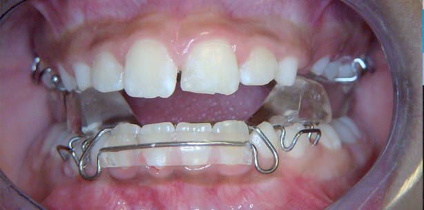 Klasse II-Anomalie – die vierte Dimension