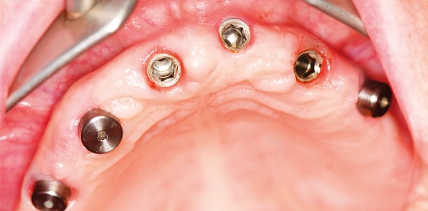 Implantatkronen
