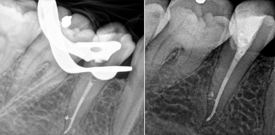 Optimiertes Aufbereitungskonzept für die Endodontie