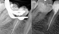 Optimiertes Aufbereitungskonzept für die Endodontie
