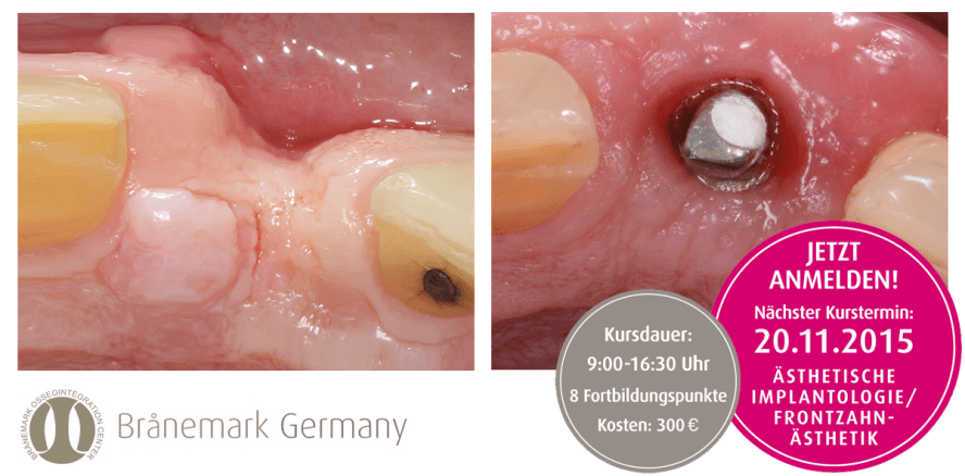 OP-Techniken in der Frontzahnästhetik. Jetzt anmelden!