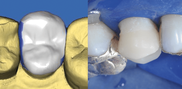 Keine Einwände mehr gegen die CAD/CAM-Technologie