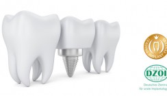 Leading Implant Centers und DZOI kooperieren