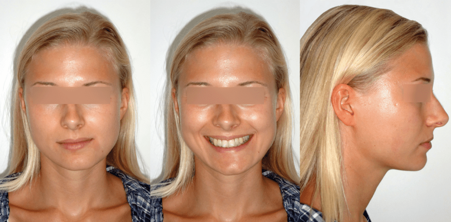 Laterognathie – konservative Korrektur mittels Lingualtechnik