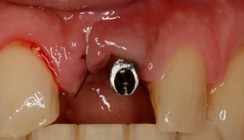 Ästhetik und Sicherheit – Ansprüche an implantatprothetische Versorgungen