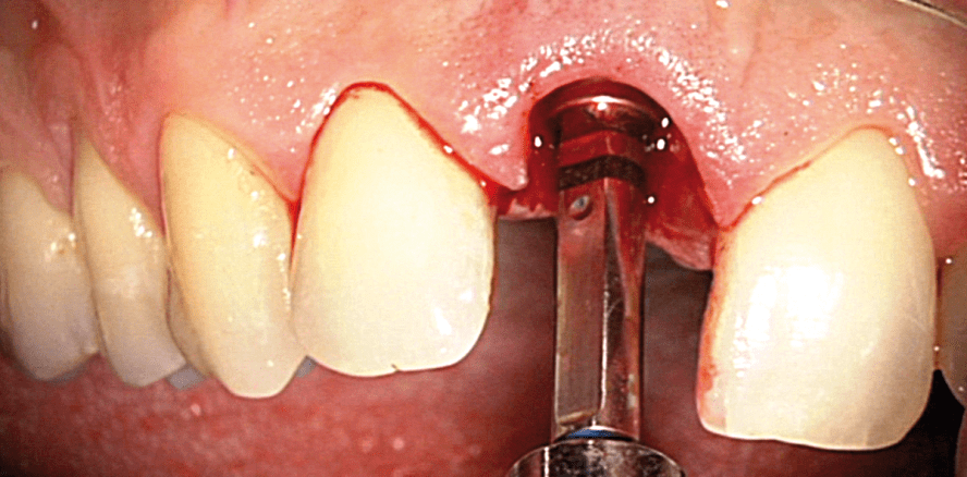 Sofortimplantation und simultane Rezessionsdeckung