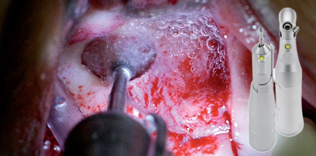 Besondere Anforderungen an oralchirurgische Instrumente