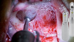 Besondere Anforderungen an oralchirurgische Instrumente