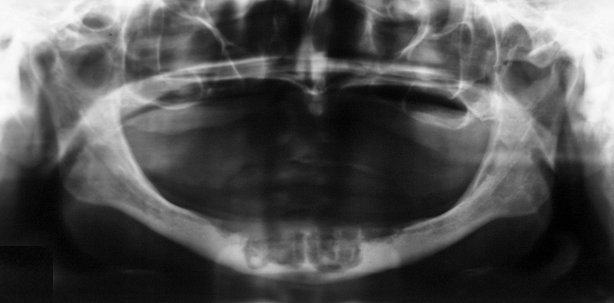 Pathogenese Bisphosphonat-assoziierter Osteonekrose