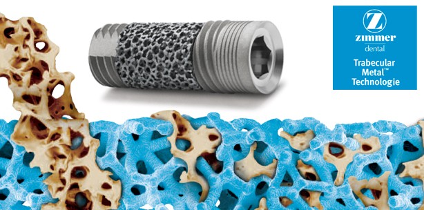 Zimmer Dental stellt Trabecular Implantat vor