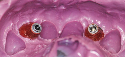 Ästhetische Frontzahnsituation durch Einsatz eines Langzeitprovisoriums