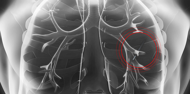 Prozess um inhalierten Zahnbohrer in der Lunge
