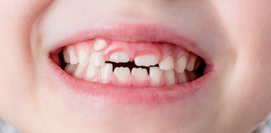 12.000 Euro Entschädigung für unbehandelte „Haifischzähne“