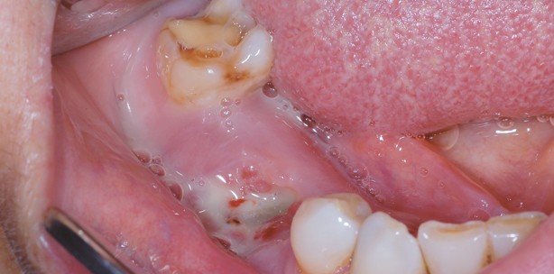 Die Bisphosphonat-assoziierte Osteonekrose der Kiefer