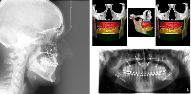 Neues Gesicht aus dem PC: Virtuelle Planung einer Kieferumstellung