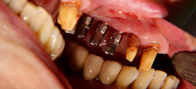 Zurück zu festsitzendem Zahnersatz
