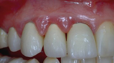 Minimalinvasive Ästhetik durch adhäsive Zahnheilkunde