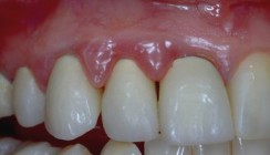 Minimalinvasive Ästhetik durch adhäsive Zahnheilkunde