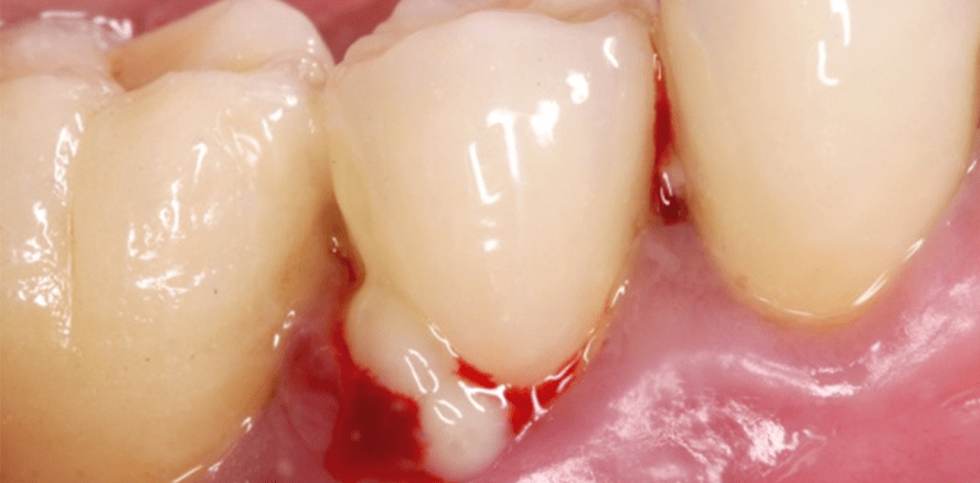 Periimplantäre Erkrankungen – Erkennen, Therapieren und Vorbeugen