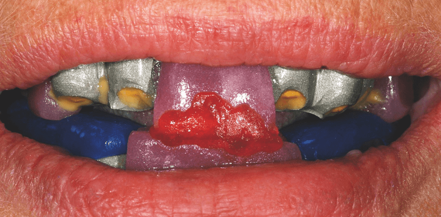 Teleskopierende Implantatprothetik mit multiplen, teilweise unbekannten Implantatsystemen