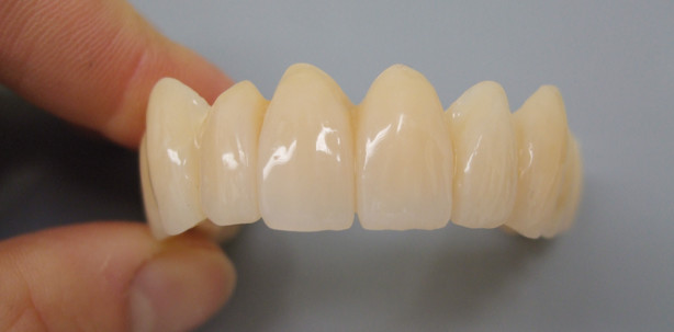 Metallfreie Teleskopprothesen – Thermoplaste als Metall-Alternative