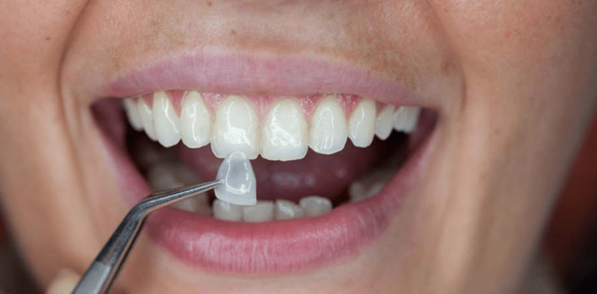 Wenn's gefällt-Veneers: Ein Lächeln zum Probetragen