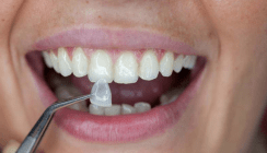 Wenn's gefällt-Veneers: Ein Lächeln zum Probetragen