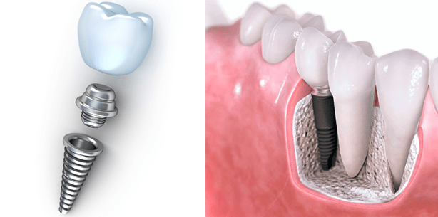 Teure Implantate – Es war einmal?