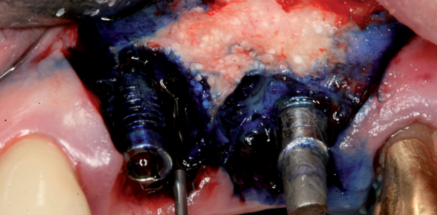 Stadiengerechte Therapie der Periimplantitis