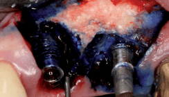 Stadiengerechte Therapie der Periimplantitis