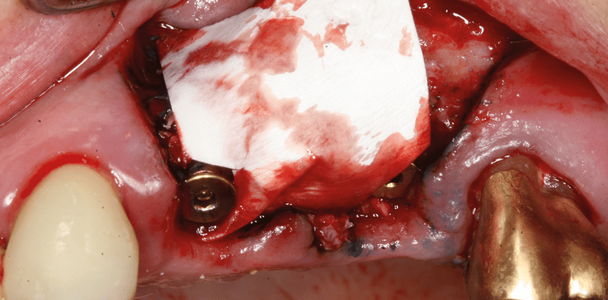 Stadiengerechte Therapie der Periimplantitis