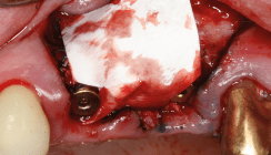 Stadiengerechte Therapie der Periimplantitis
