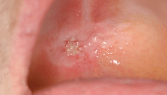 Therapie von oralen Leukoplakien und malignen Mundschleimhautläsionen