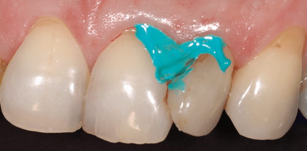 Thixotroper Wundverband zur Hämostase bestätigt