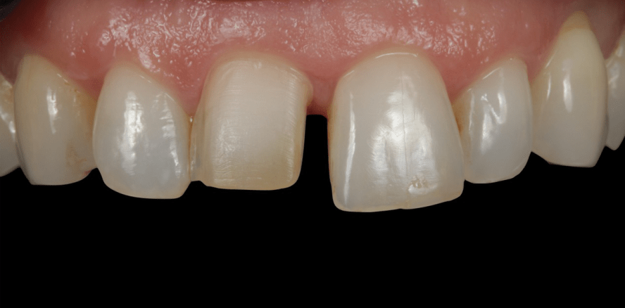 Veneers: Welcher IPS e.max Press-Rohling für welchen Patientenfall?