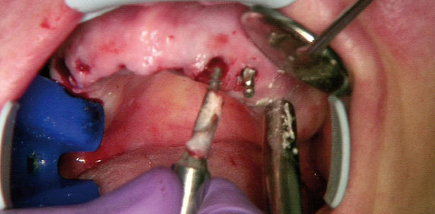 Entfernung einteiliger Implantate bei Titanunverträglichkeit