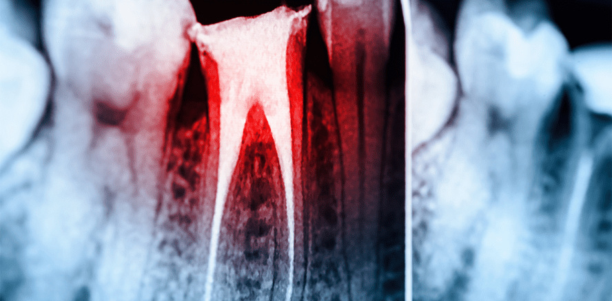 Tod nach Wurzelbehandlung: Junger Patient stirbt in Zahnarztpraxis