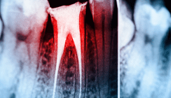 Tod nach Wurzelbehandlung: Junger Patient stirbt in Zahnarztpraxis