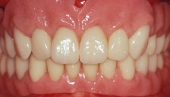 Typgerechte Zahnaufstellung in der Total- und Hybridprothetik