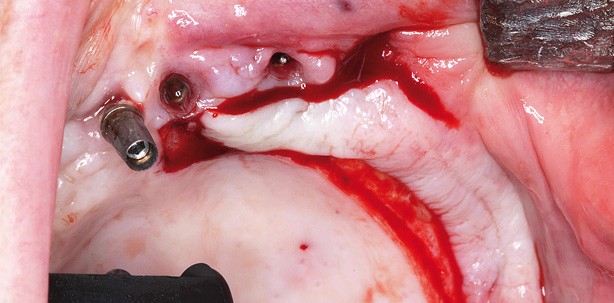 OK-Rehabilitation mit intraoralen Knochentransplantaten