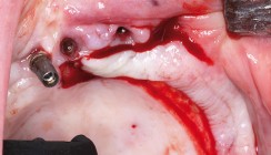 OK-Rehabilitation mit intraoralen Knochentransplantaten