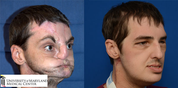 Rekord-OP: Amerikaner erhält nach Schussverletzung neues Gesicht